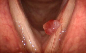 Polyp có phải là ung thư không? Polyp có bao nhiêu loại?