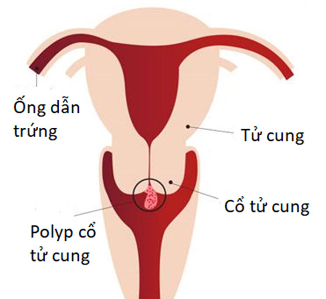 polyp-co-tu-cung-co-gay-ung-thu-khong-1