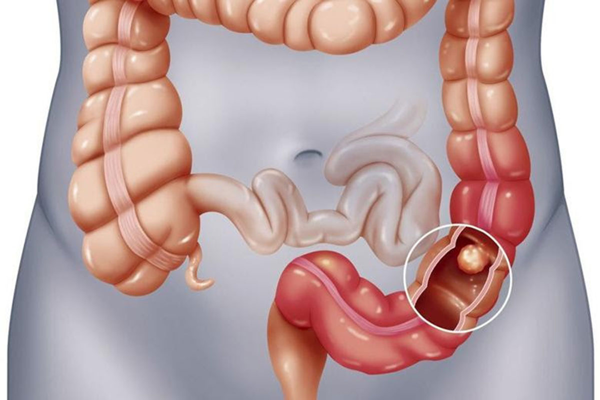 polyp-dai-trang-ac-tinh-1