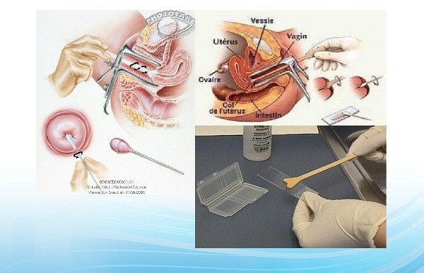Cách phòng bệnh ung thư cổ tử cung