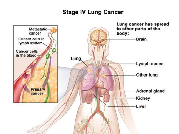 Ung thư phổi giai đoạn cuối có khả năng di căn đến nhiều cơ quan, trong đó có xương