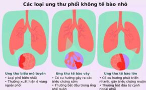 Ung thư phổi không tế bào nhỏ và những thông tin cần biết