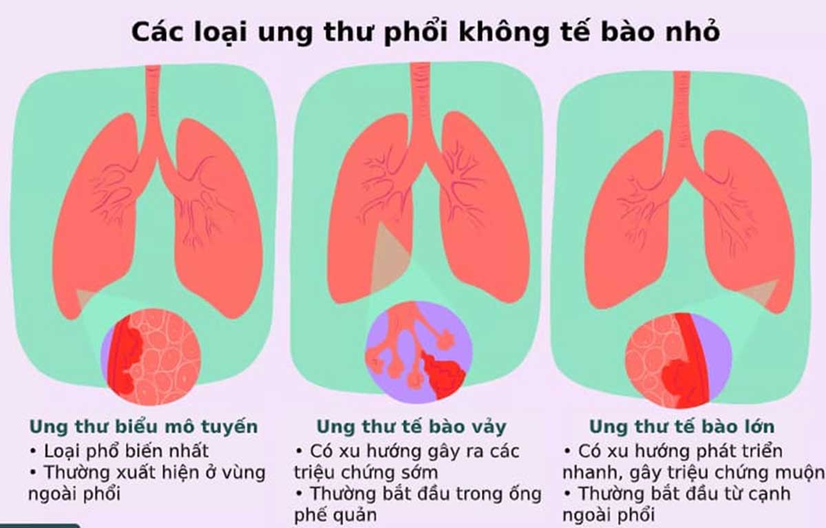 ung-thu-phoi-khong-te-bao-nho-1