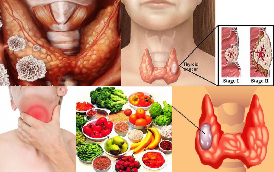 Đau khi nuốt, ngay cả với thức ăn lỏng là biểu hiện thường gặp ở bệnh nhân ung thư tuyến giáp giai đoạn cuối