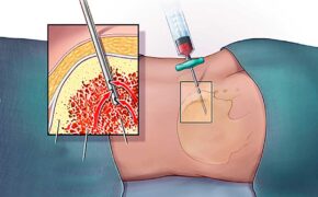 Những phương pháp xét nghiệm ung thư xương và các lưu ý quan trọng