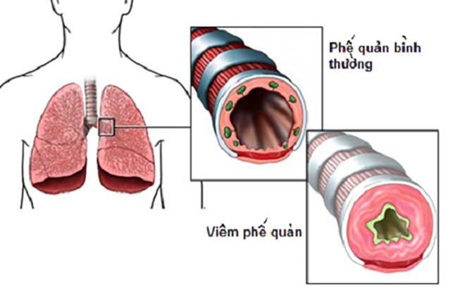 viem-phe-quan-la-gi