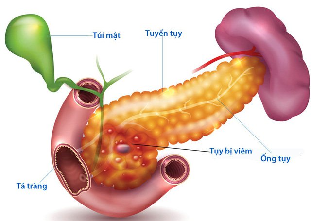 Viêm tụy ở trẻ em