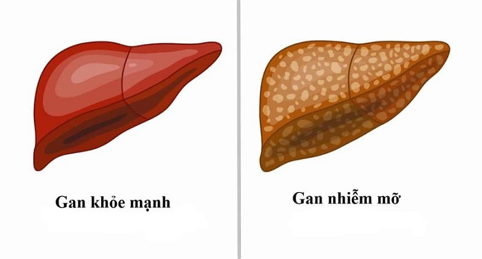 gan-nhiem-mo-la-gi