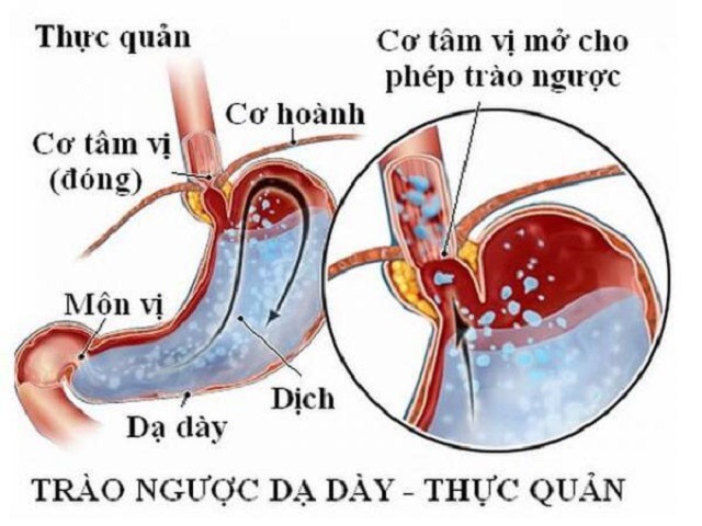 trao-nguoc-thuc-quan-gay-kho-tho