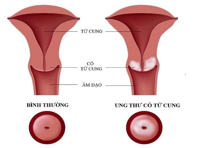 ung-thu-co-tu-cung