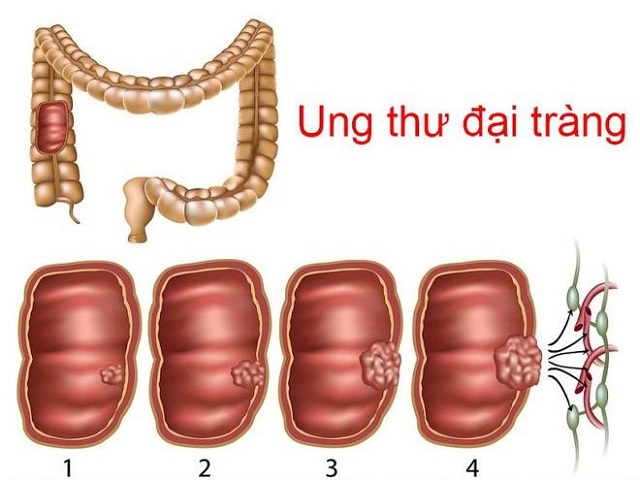 ung-thu-dai-trang-di-can-xuong