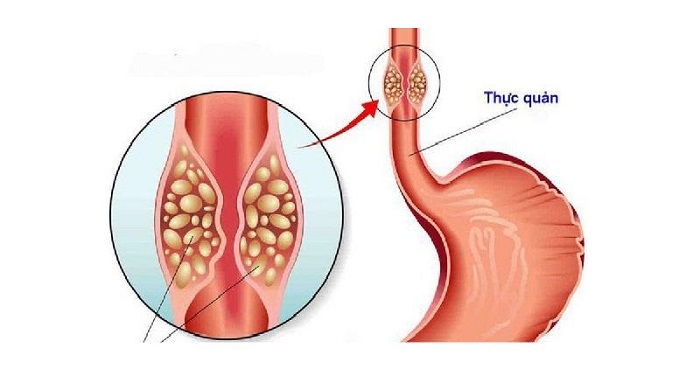 hep-thuc-quan