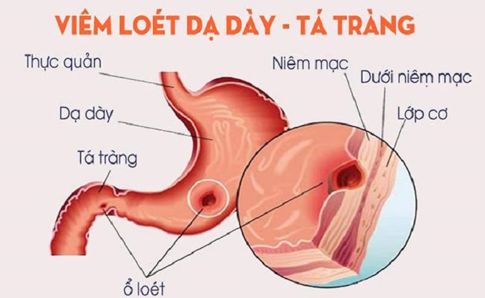 viem-loet-da-day-ta-trang