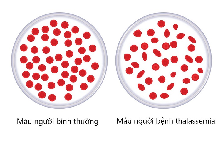 benh-tan-mau-bam-sinh-song-duoc-bao-lau-