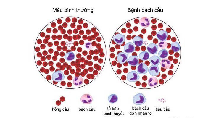 Ung thư máu M3 có thể diễn biến như thế nào?
