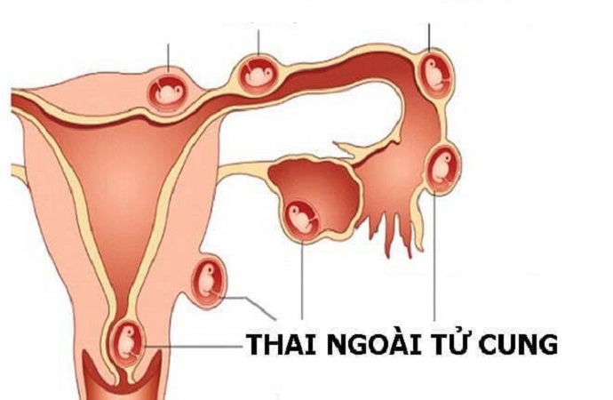 mo-thai-ngoai-tu-cung-1